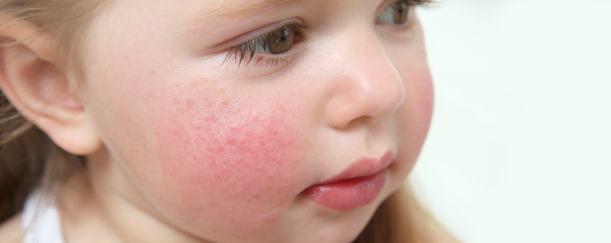 ¿Cómo se trata la dermatitis atópica de un niño?