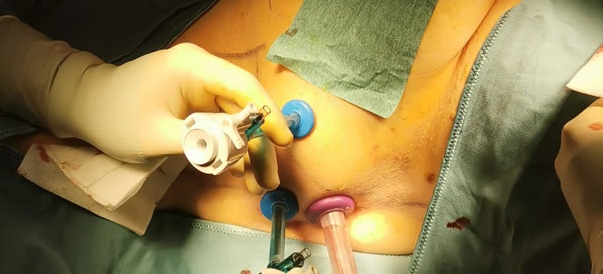 Cirugía de mama