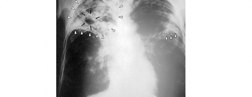 L’HUMT participarà en un assaig clínic que estudia l’acceleració de la curació de la tuberculosi