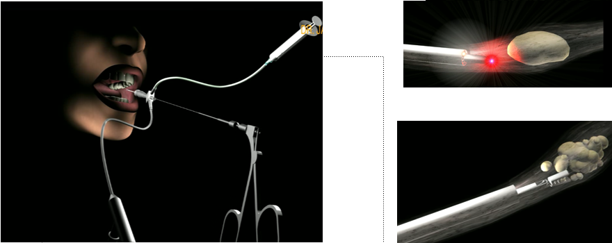 El Servei de Cirurgia Oral i Maxil·lofacial de l’HUMT, pioner al Vallès en el tractament de la patologia glandular mitjançant sialoendoscopia